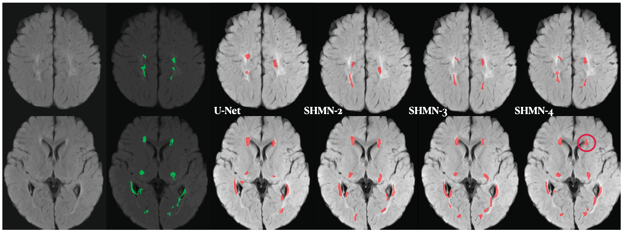 PVL segmentation results