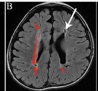  The shcematic MRI image(the lesion region) 