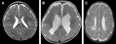  Another symptoms of PVL 