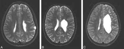  Another symptoms of PVL 